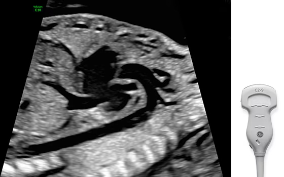 Ultrasound image captured with XDclear probe.