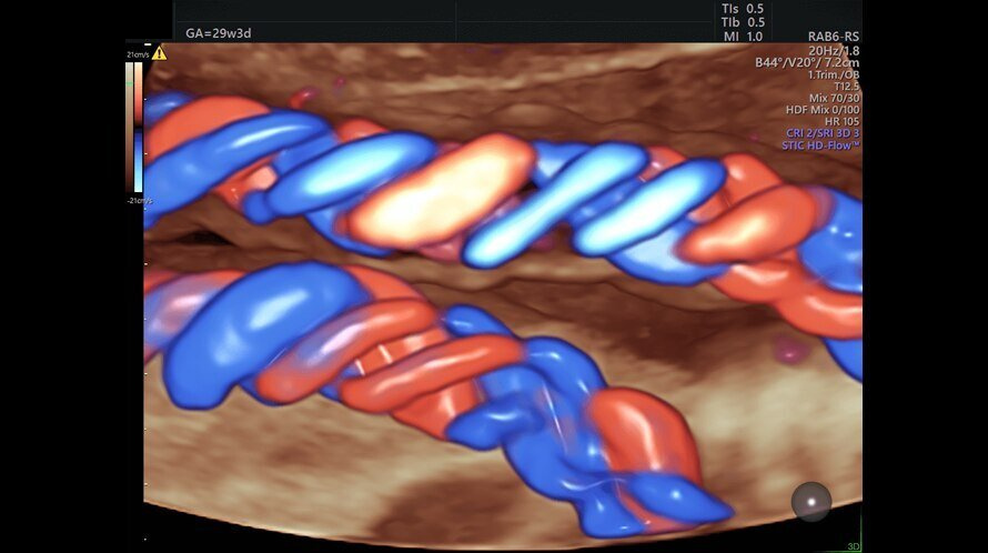 Ultrazvukový snímek srdce plodu zachycený pomocí funkce Radiantflow
