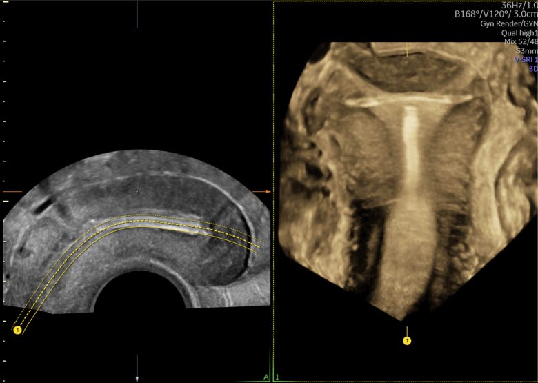 Ultrazvukový snímek s IUD zachycený pomocí funkce OmniView