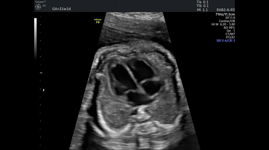 Ultrazvukový snímek srdce