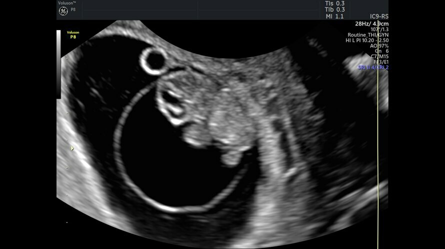Ultrazvukový snímek devítitýdenního plodu