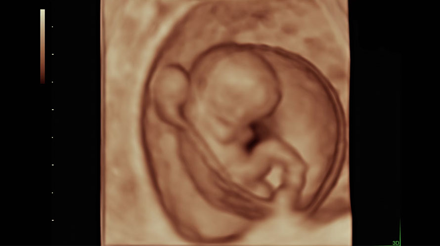 Ultrazvukový snímek devítitýdenního plodu