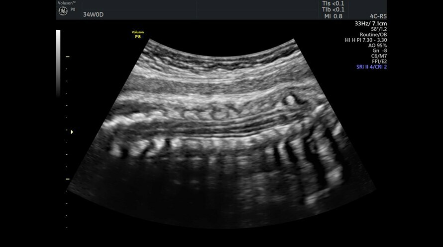 Ultrasound image of the fetal spine