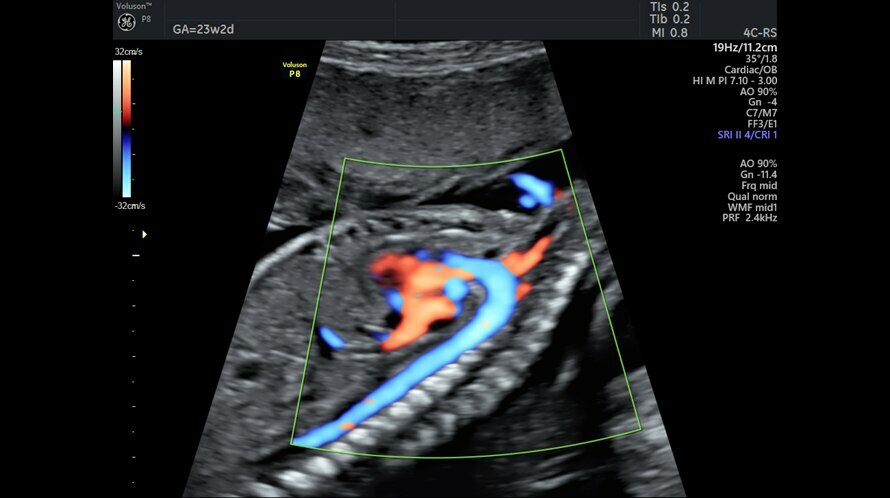 Obraz USG łuku aorty uchwycony z wykorzystaniem funkcji HD-Flow