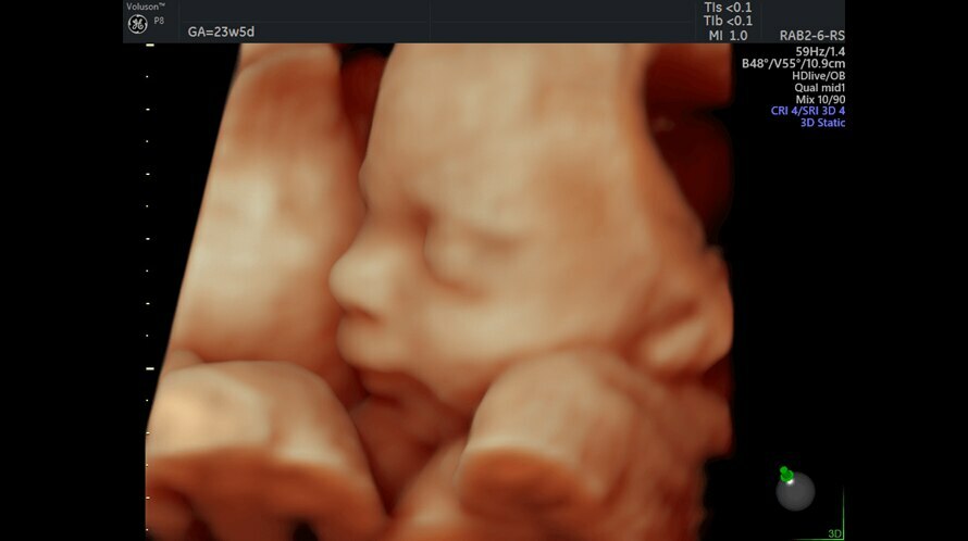 Fetal face with HD<em>live</em> Studio