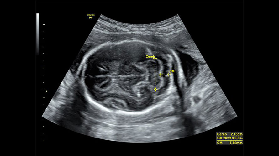Ultrasound image of a fetal cerebellum and cisterna magna