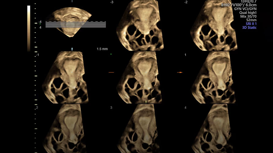Ultrazvukový snímek dělohy pomocí tomografického ultrazvukového zobrazení (TUI)