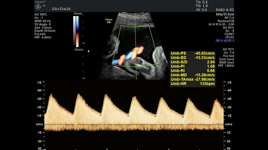 Ultrazvukový snímek zachycený pomocí Dopplerovského zobrazení pupečníku