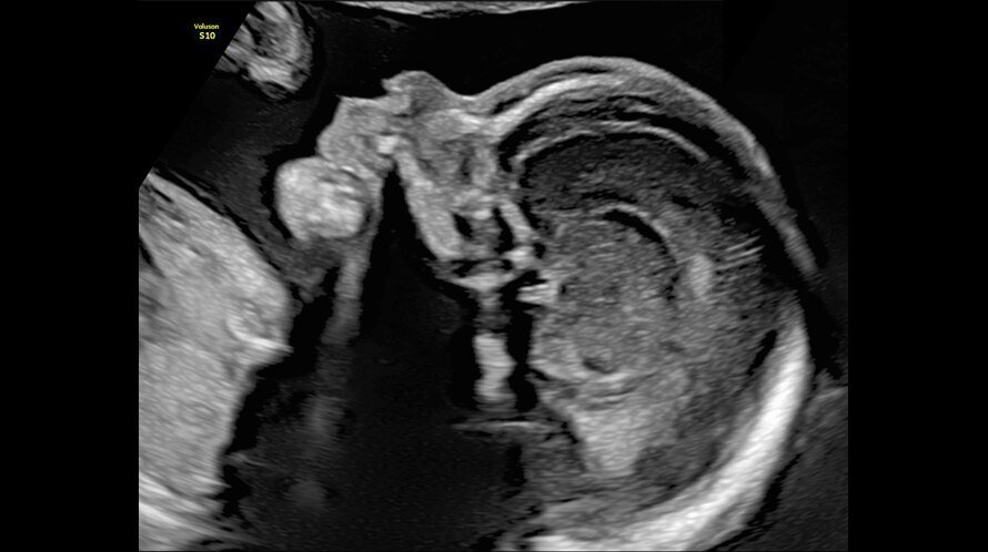 Ultrasound image of a fetal profile