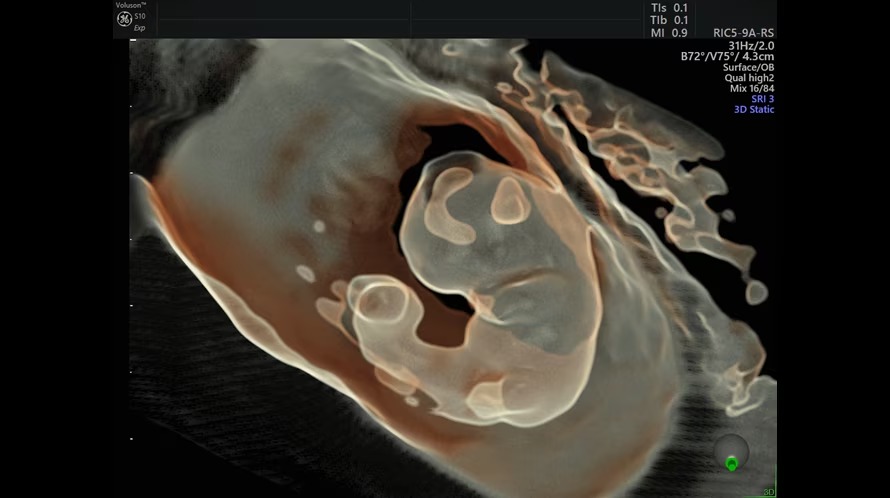 Ultrazvukový snímek osmitýdenního plodu zachycený pomocí funkce HDlive Silhouette