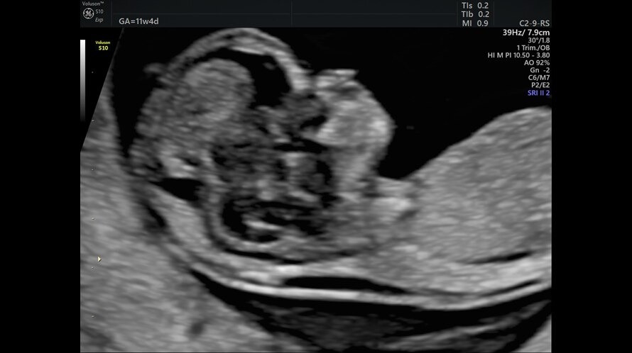 Ultrasound image of a fetus