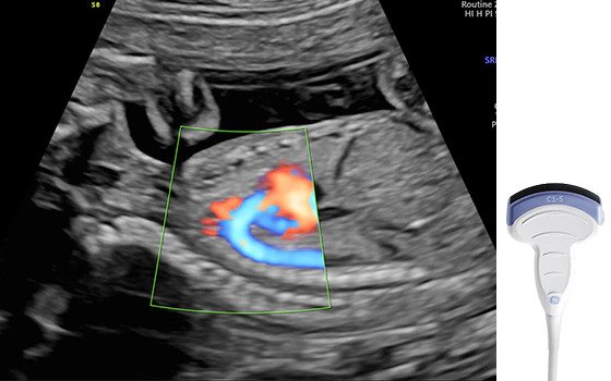 Ultrasound image captured with C1-5-RS probe