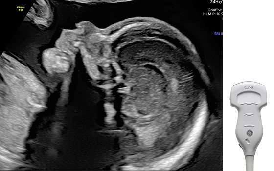 Ultrazvukový snímek profilu plodu zachycený pomocí sondy C2-9-RS