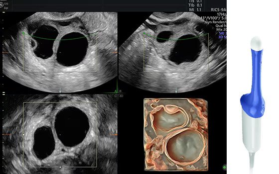 Ultrasound image captured using RIC5-9-RS probe