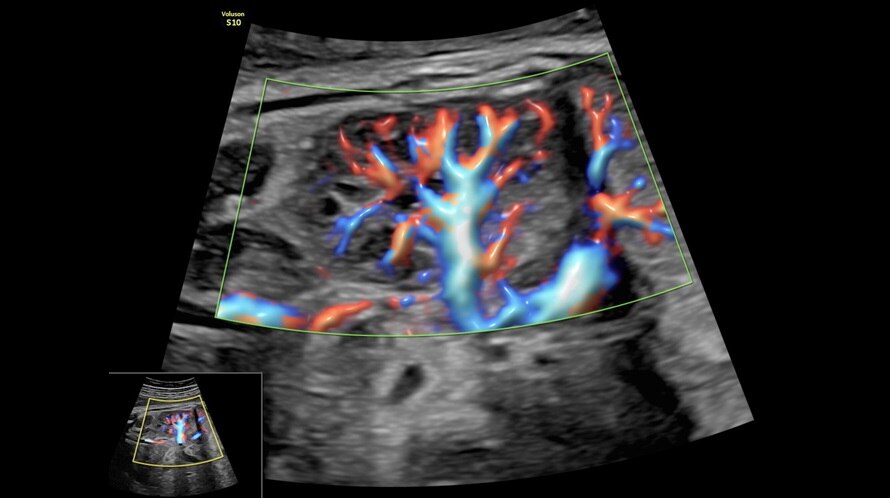 Ultrazvukový snímek ledviny plodu zachycený pomocí funkce Radiantflow