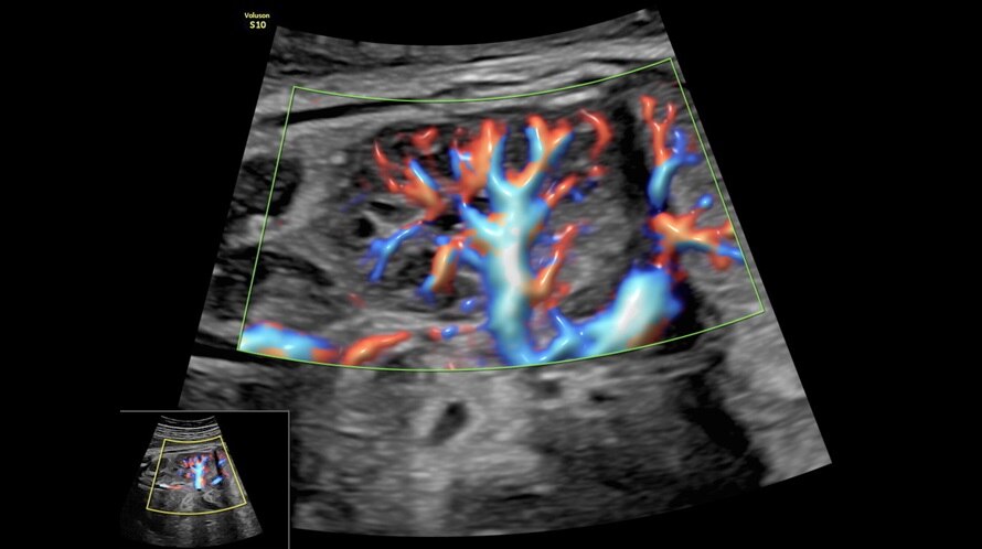 Obraz USG nerki płodu uchwycony z wykorzystaniem funkcji Radiantflow