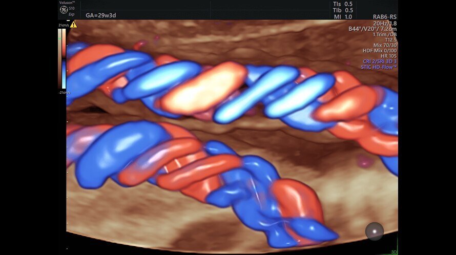 Ultrazvukový snímek srdce plodu zachycený pomocí funkce Radiantflow