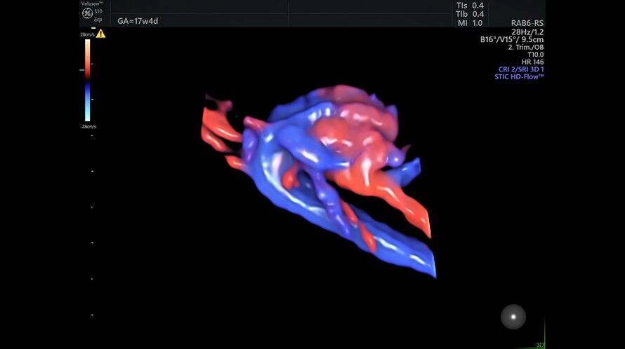 Ultrasound image captured using HD Flow