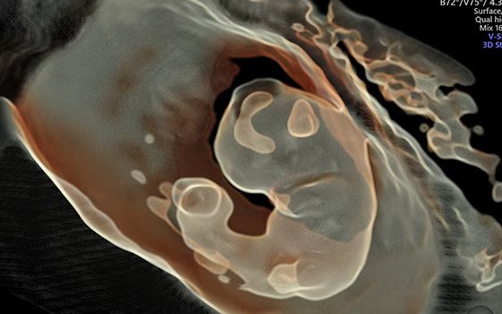 Ultrasound image of a fetus captured using HDlive Silhouette