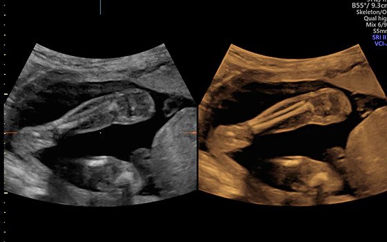 Ultrazvukový snímek zachycený pomocí objemového kontrastního zobrazování (VCI)