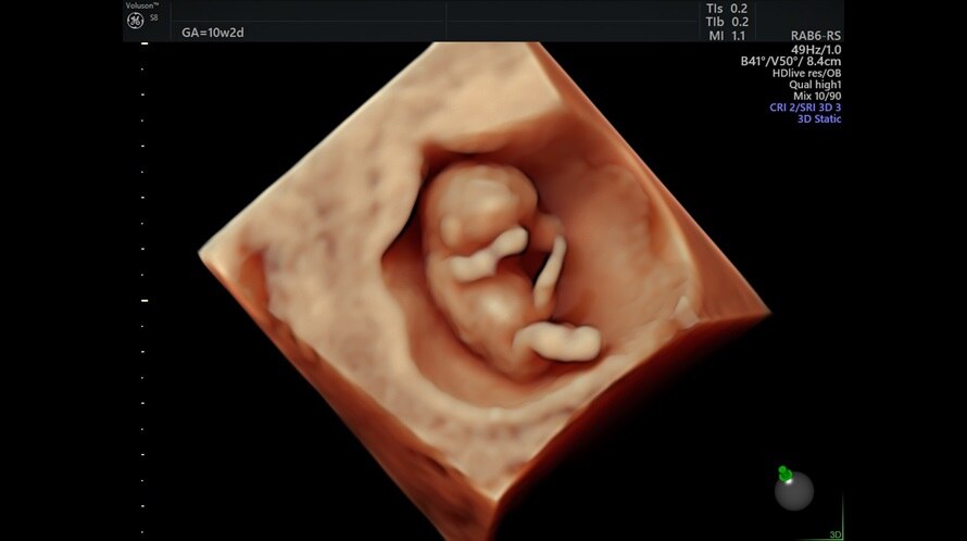Image échographique d'un fœtus de 10 semaines