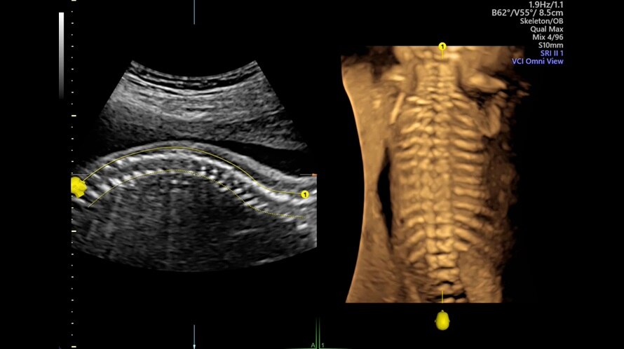 Ultrazvukový snímek fetální páteře