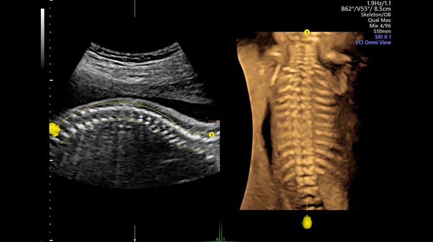 Obraz USG kręgosłupa płodu