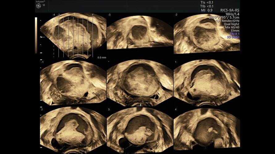 Ultrazvukový snímek komplexní ovariální masy