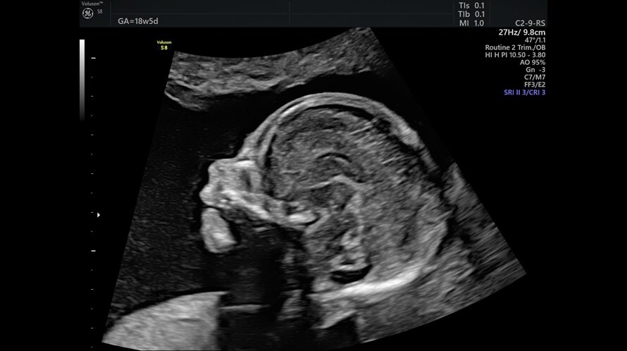 Ultrasound image of a fetal profile