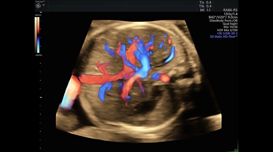 Ultrazvukový snímek fetálního srdce zachycený pomocí funkce Radiantflow