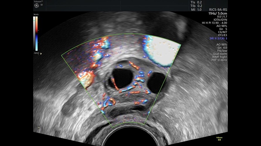 Ultrazvukový snímek vaječníků zachycený pomocí funkce HD-Flow