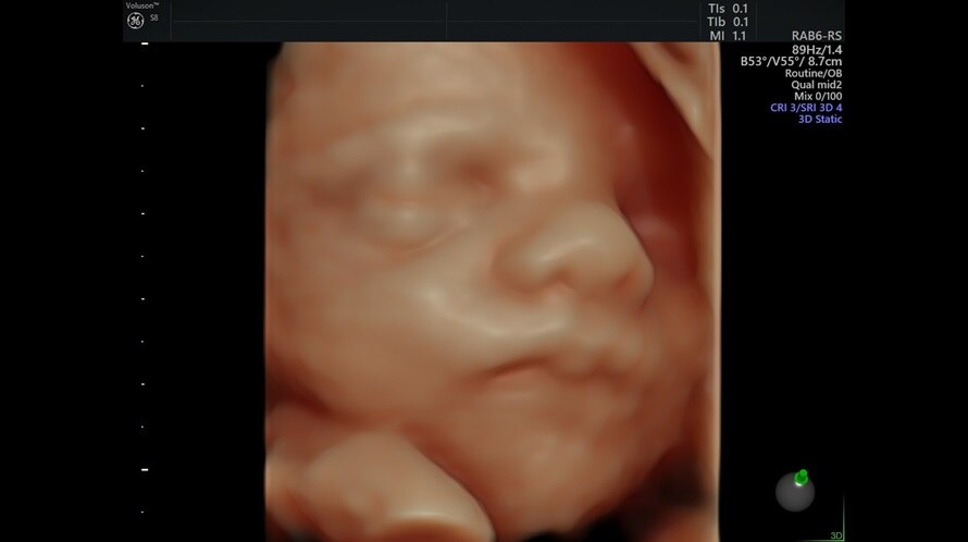 Εικόνα υπερήχου ενός εμβρυϊκού προσώπου που αποτυπώθηκε με τη χρήση του HDlive
