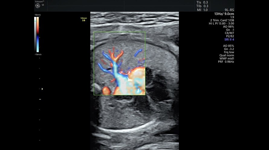 Ultraschallbild des fetalen Herzens mit Radiantflow