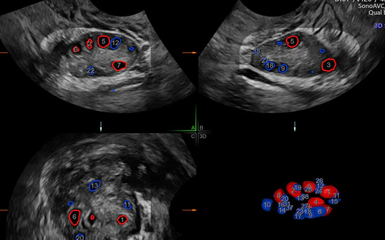 Ultrazvukový snímek zachycený pomocí funkce SonoAVCfollicle