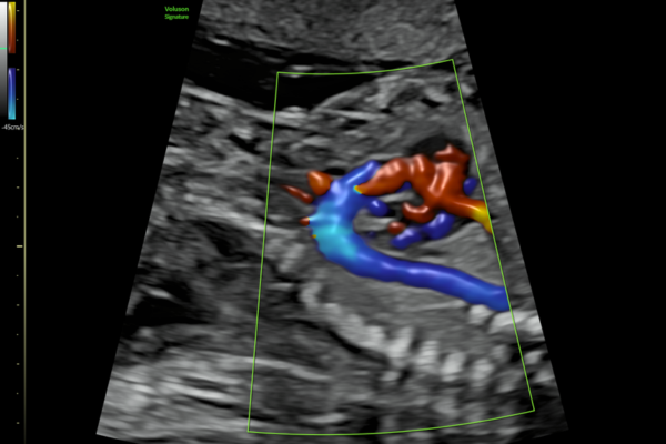 Color Doppler ultrasound showing 3D-like rendering of blood vessels in red and blue against grayscale tissue background.