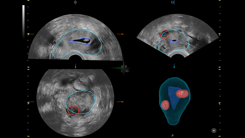 clinical image with SonoGyn